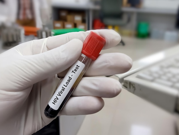 Test Tube with blood sample for HIV viral load testing