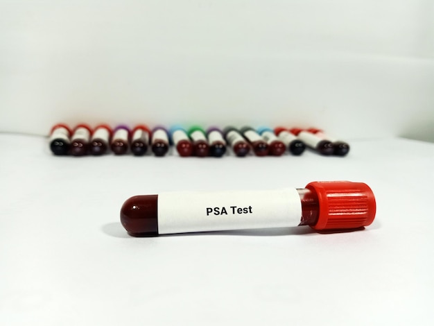 Test Tube with blood sample for PSA test Medical testing concept