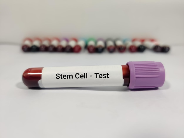 Test Tube with blood sample for Stem Cell Test