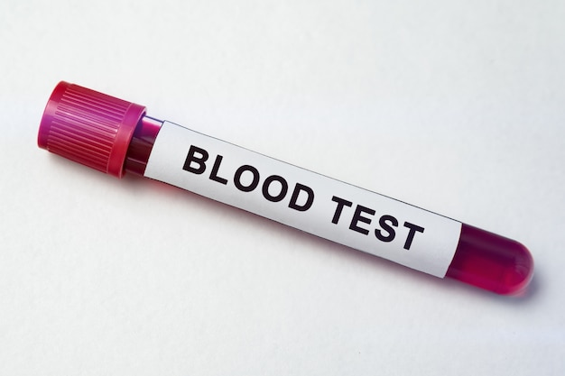 Test tubes with blood on white background. tube of biological sample