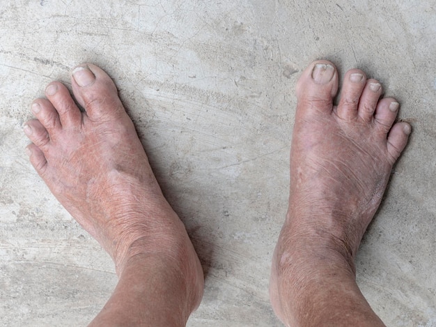 Top down view foot of elderly woman