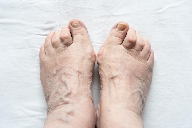 Top view of female feet together with hammer toes broken nails and dry skin over white background