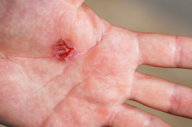 Torn callus of the hand closeup rough skin of male hand