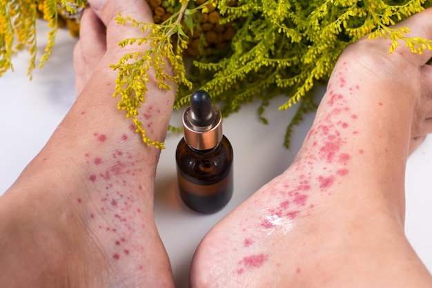 Treatment of infectious foot disease with oils and medicinal herbs Foot fungus and allergic rash