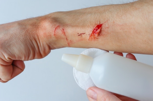 Photo treatment of a laceration with help disinfectant first aid for trauma