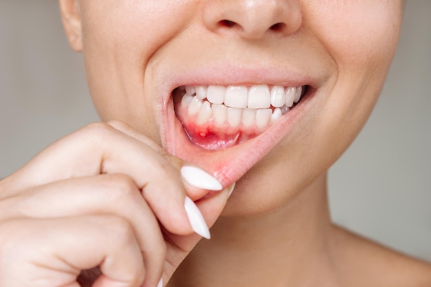 Ulcerative stomatitis on the gums. Gum inflammation. Young woman showing red gingiva with an ulcer