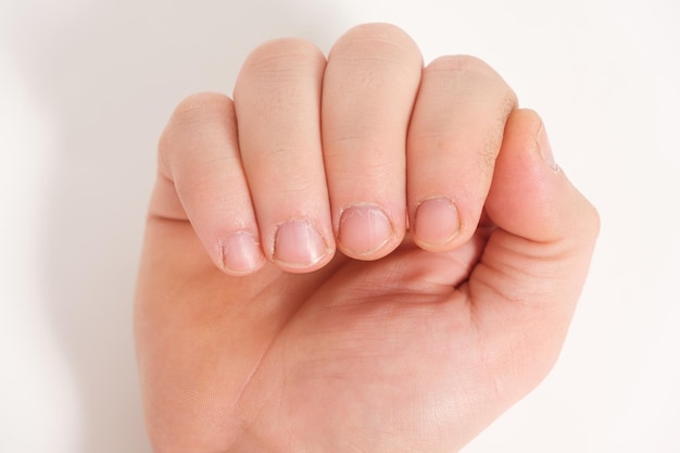 Unkempt male nails with a regrown cuticle on a white background