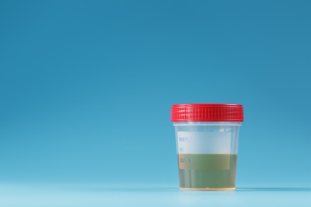 Urine in a test container with a red lid on blue