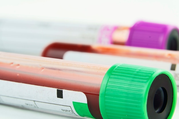 Photo vacuum tubes for collection and blood samples and a syringe isolated on background selective focus