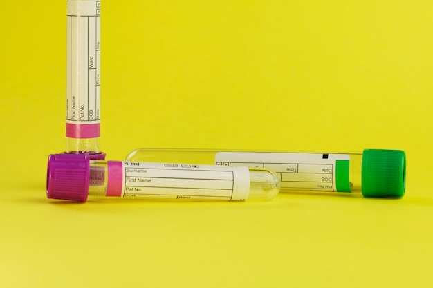 Vacuum tubes for collection and blood samples on yellow background.
Transparent with purple and green lid. Label to identify the data. Selective focus.