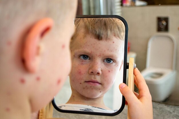 Photo varicella virus or chickenpox bubble rash on child