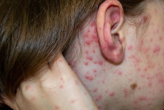 Varicella virus or Chickenpox bubble rash on child