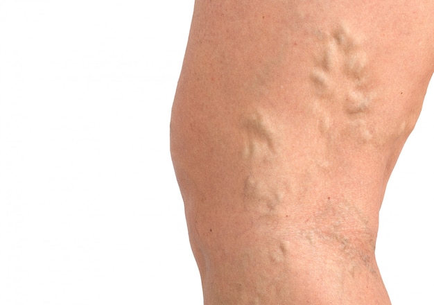 Varicose veins on the skin macro close up circulation problem medicine