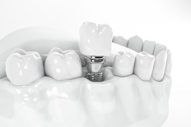 View from above of a false tooth implant fixed in the jawbone; 3D; 3D Illustration