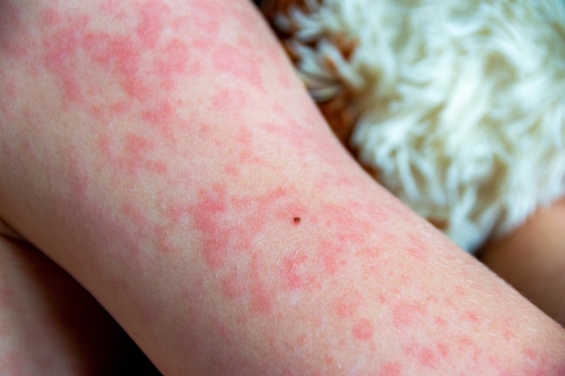 Viral disease Measles rash on the body of the child Allergy