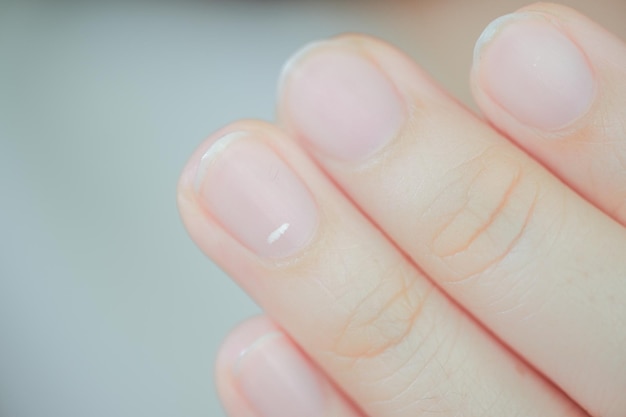 White spots on finger nails called leukonychia reveal the emergence of health problems