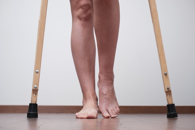 A woman after a broken leg to learn to walk. Rehabilitation after removal of plaster bandage.