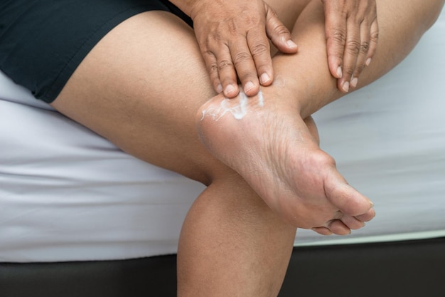 Woman care feet with cracked and dry heel skin cream at home