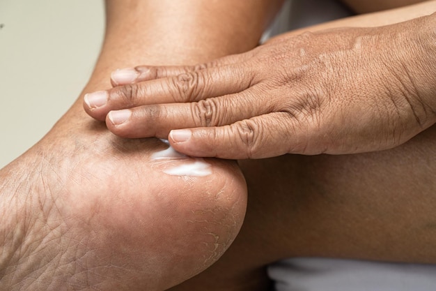 Woman care feet with cracked and dry heel skin cream at home