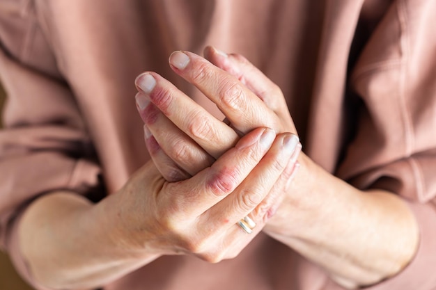 Woman hands with atopic dermatitis eczema allergy reaction on skin