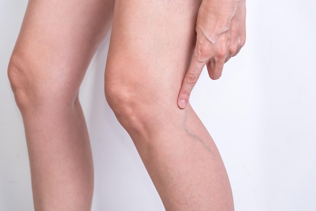 Woman indicating varicose veins veins poor circulation