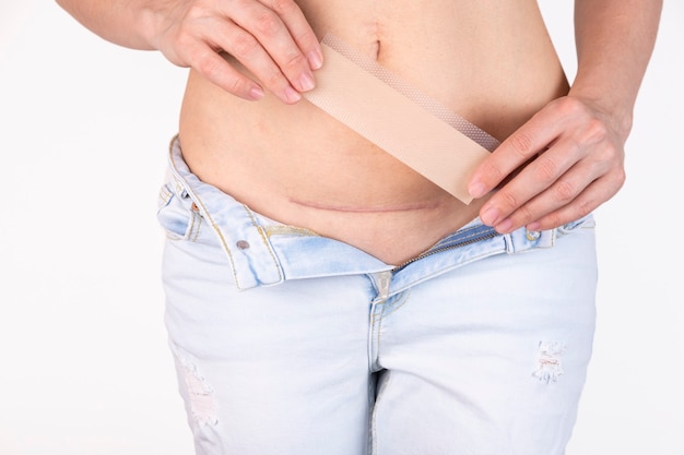 Woman is applying patch with a silicone sheeting on her scar after C-section surgery