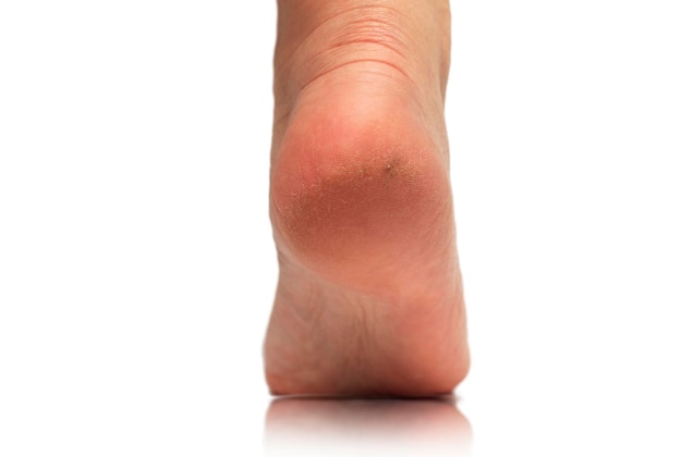 A woman's leg with cracks and dryness on the heel closeup on a white background The concept of problems with the skin of the legs and feet and their treatment