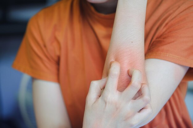 Photo woman scratched her arm because it was itchy a red rash from an allergic reaction or an insect bite