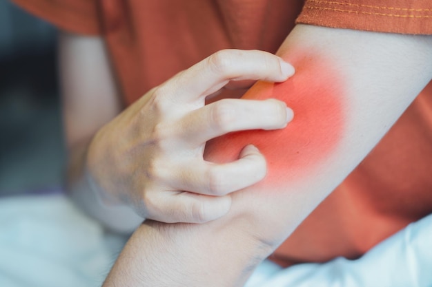 Woman scratching her arm due to irritation from insect bites