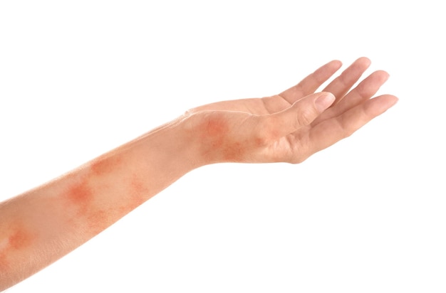 Woman showing hand with dry skin on white background closeup