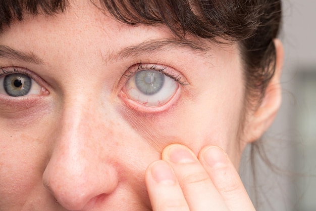 Woman with cataract on eye and corneal opacity