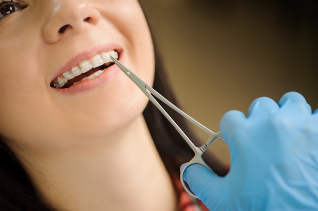 Woman with ceramic braces on teeth at the dental office