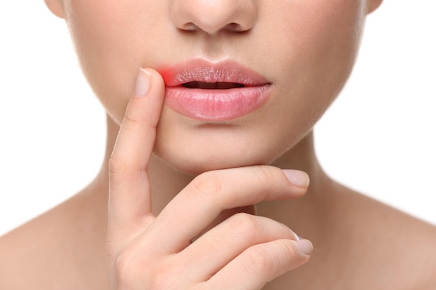 Woman with cold sore touching lips on white background