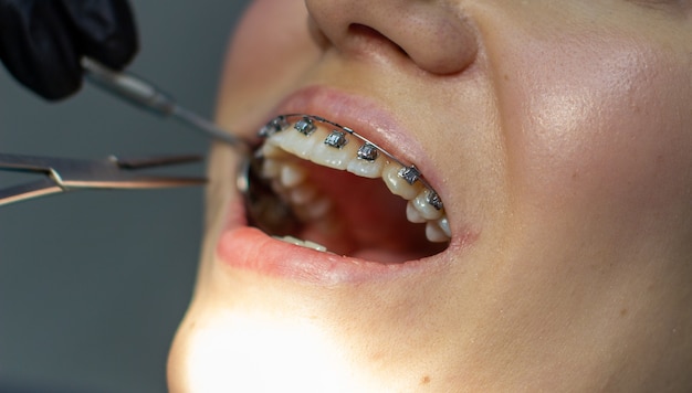 A woman with dental braces visits an orthodontist in the clinic in a dental chair