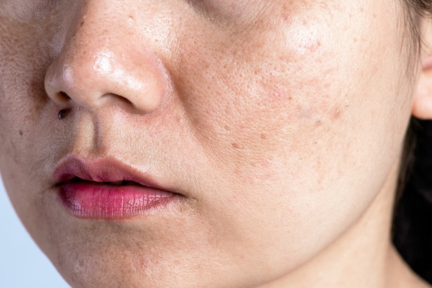 Woman with problematic skin, acne scars, wrinkles and dark spots.