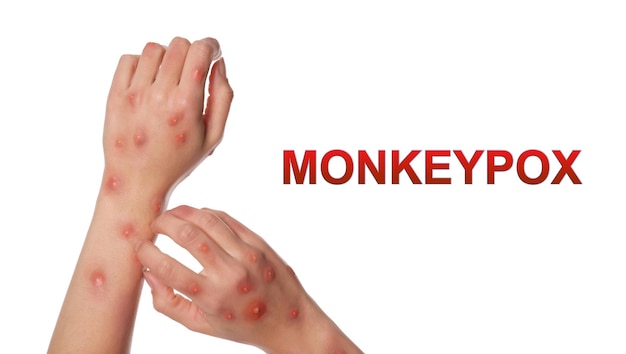 Woman with rash suffering from monkeypox virus on white background closeup