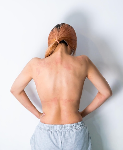 Photo woman with skin allergy all over her body showing her back part with red rash and skin infection