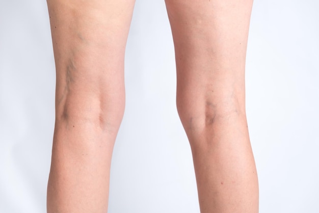 womans legs with genu valgus and many varicose veins bad posture