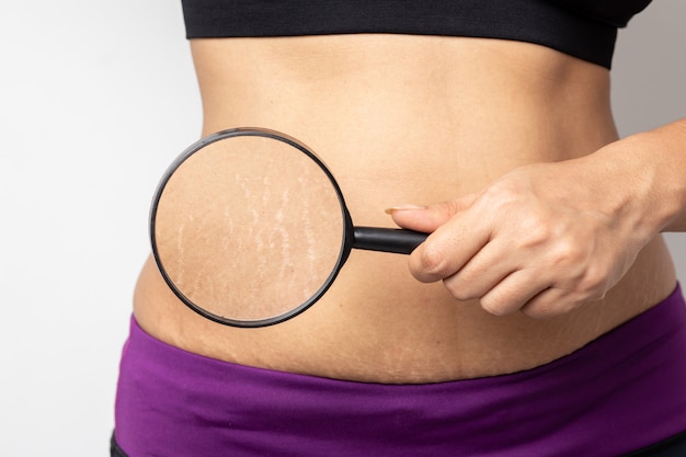 Women Show off the belly after birth Stretch Marks on white background