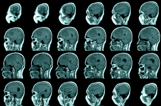 World Stroke day MRI BRAIN show reveals a wellcircumscribedextraaxial mass