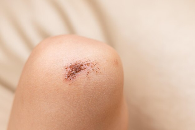 Wound on the knee of a small child