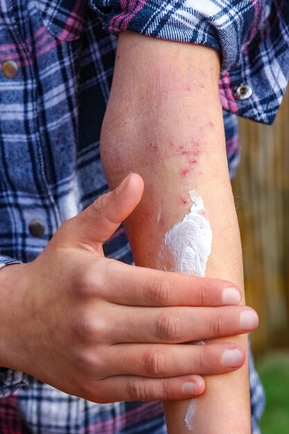 Photo a wounds atopic dermatitis in the hands of a child