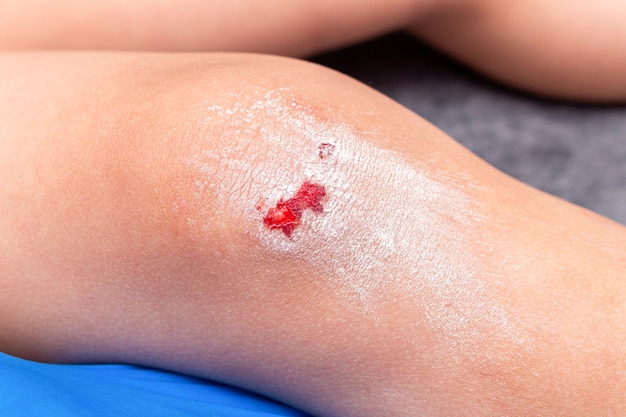 Wounds, scratches, abrasions on the childâs leg, knee close up