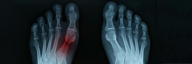 X ray of feet with tarsal fracture closeup