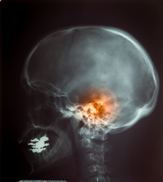 X ray film for human skull