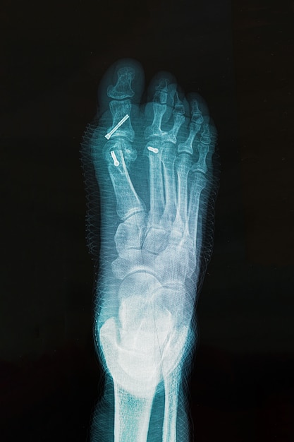 Photo x-ray of foot after surgery to correct hallux varus condition.