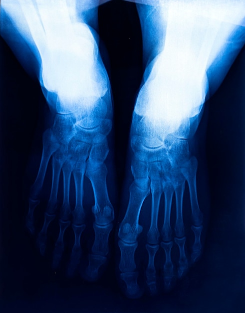 Photo x-ray humans ankle with arthritis  top view