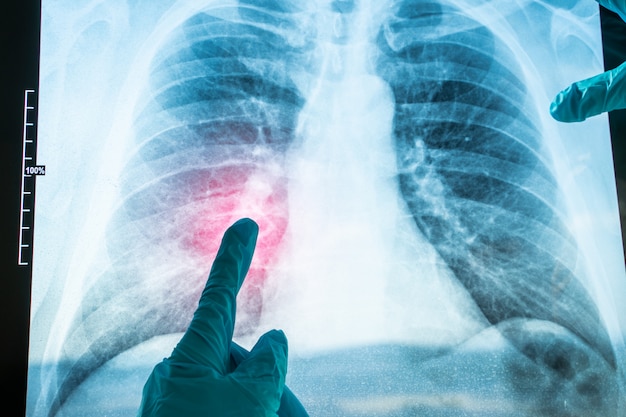 X-Ray image of human chest for a medical diagnostic. Coronavirus-COVID-19. Epidemic virus 2019-nCoV Respiratory Syndrome.