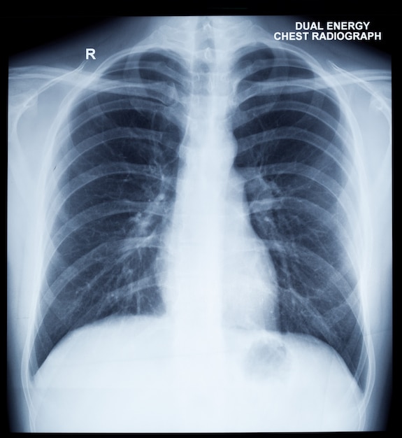 X-Ray Image Of Human Chest