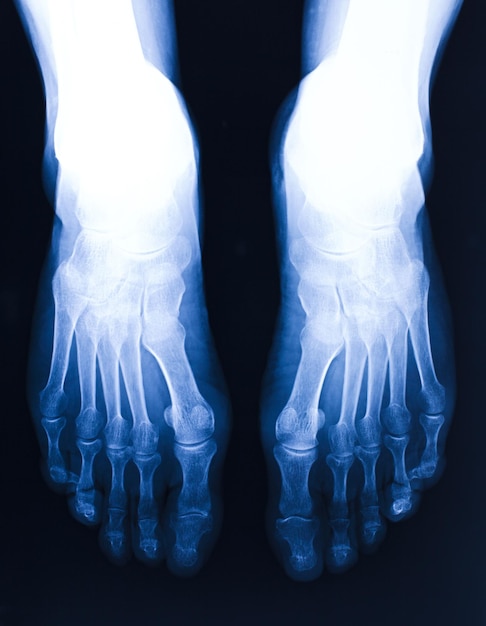 Photo x-ray image of human feet